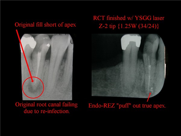 Harris CEREC.RCT.jpg